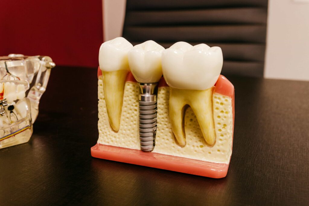 The 5 Stages of Tooth Enamel Erosion Explained 1 tooth replacement model